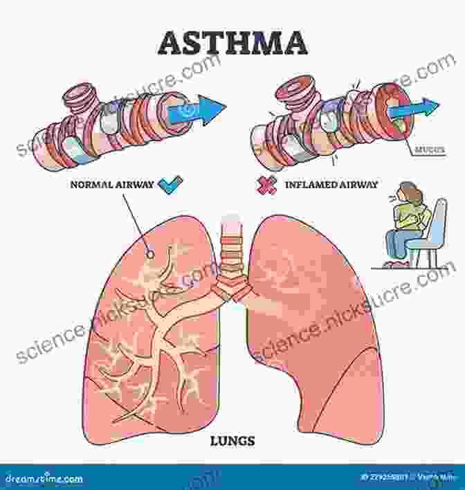 Asthma Illustration Showing Inflamed Airways The Peanut Allergy Epidemic Third Edition: What S Causing It And How To Stop It