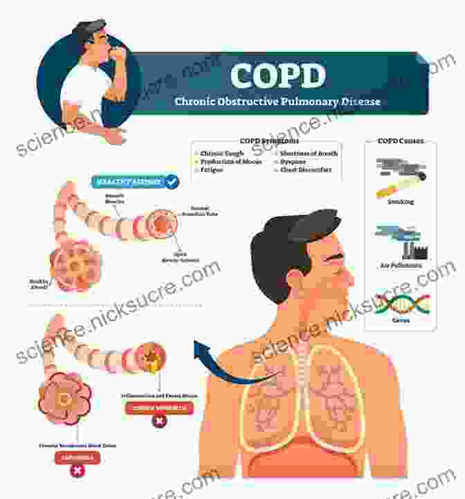 COPD Illustration Showing Damaged And Obstructed Airways The Peanut Allergy Epidemic Third Edition: What S Causing It And How To Stop It