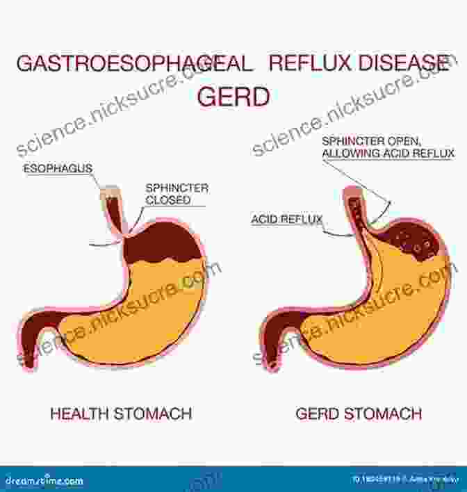 GERD Illustration Showing Stomach Acid Refluxing Into The Esophagus The Peanut Allergy Epidemic Third Edition: What S Causing It And How To Stop It