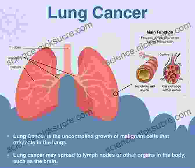 Lung Cancer Illustration Showing A Tumor In The Lung The Peanut Allergy Epidemic Third Edition: What S Causing It And How To Stop It